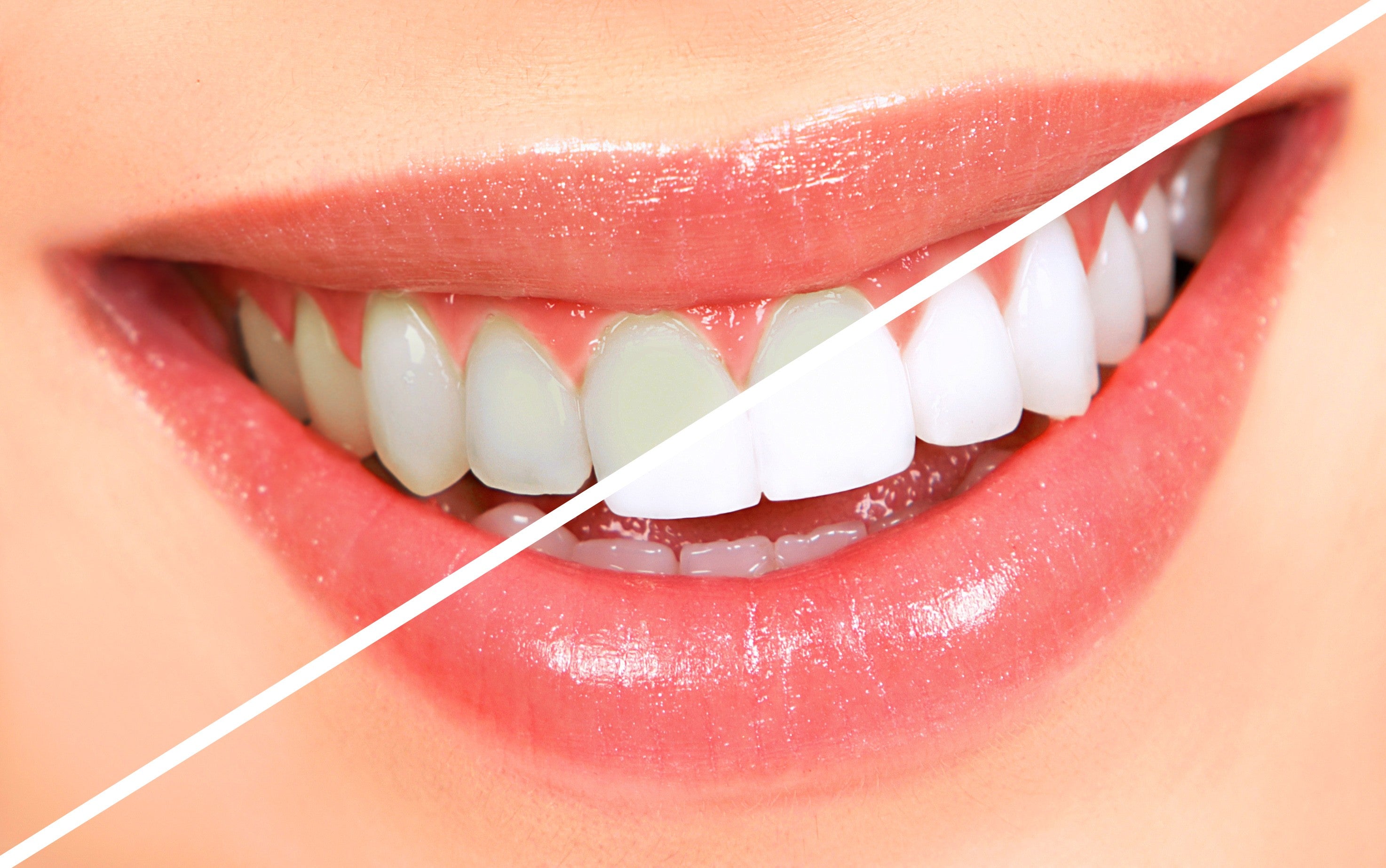 Kit de blanqueamiento dental